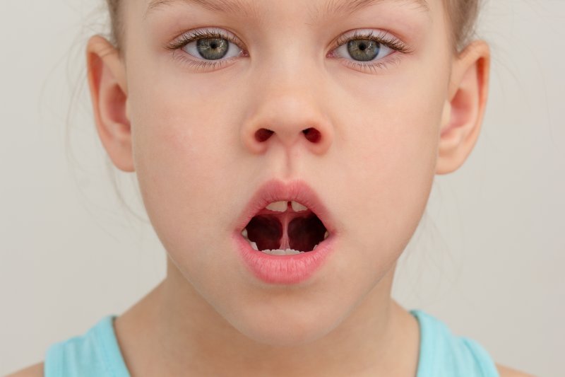 Child with large tongue-tie 