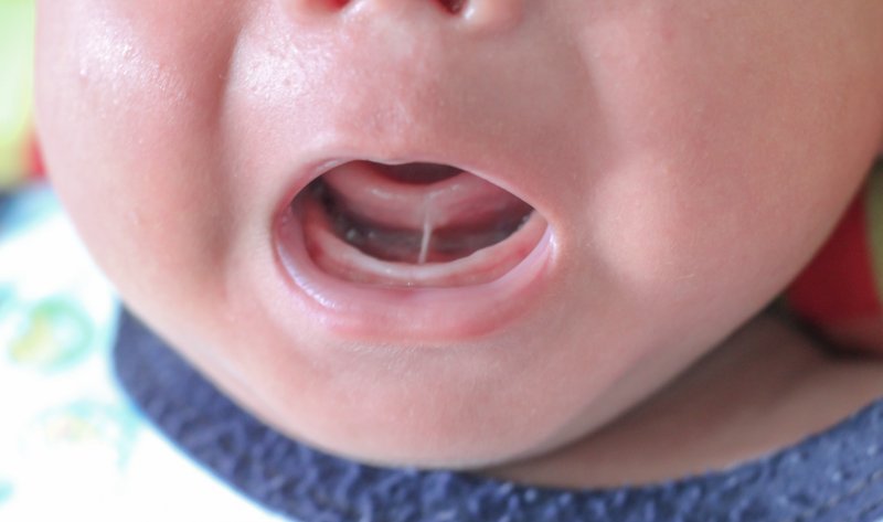 up-close view of baby with a tongue-tie 